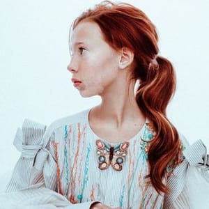 Vitiligo Diana