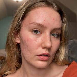 Blemish Queen