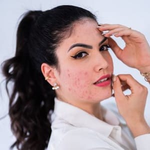 Su Neves | Acne | Skincare